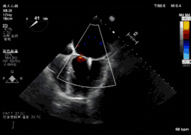 葛均波院士團隊完成一例新一代超聲引導下的ValveClamp術